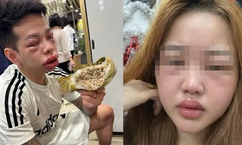 Ăn món "lạ" người phụ nữ mặt sưng húp, bác sĩ chỉ mặt điểm tên lý do cực độc