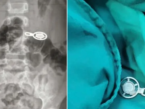 Nuốt móc khóa khi ngủ trưa, bé 4 tuổi phải nhập viện cấp cứu