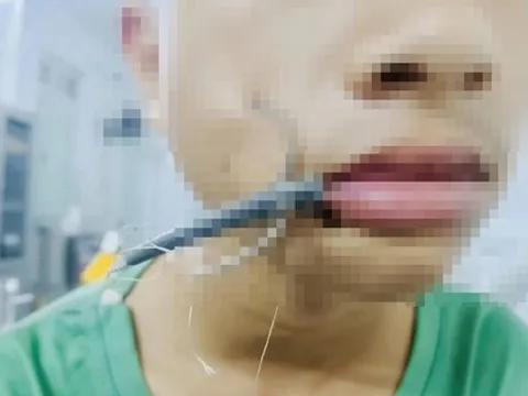 Bé trai 15 tuổi đau dữ dội vùng má, bác sĩ lấy ra thứ "đáng sợ" bên trong