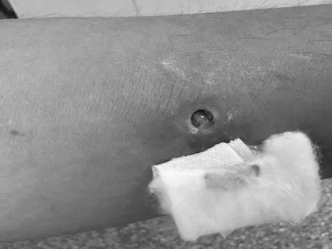 Ghi nhận ca mắc giun rồng thứ 44 tại Việt Nam